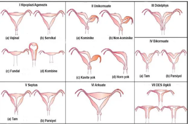 Şekil 2.4. ASRM’ye göre konjenital dişi genital sistem anomalilerinin sınıflandırılması (16) 