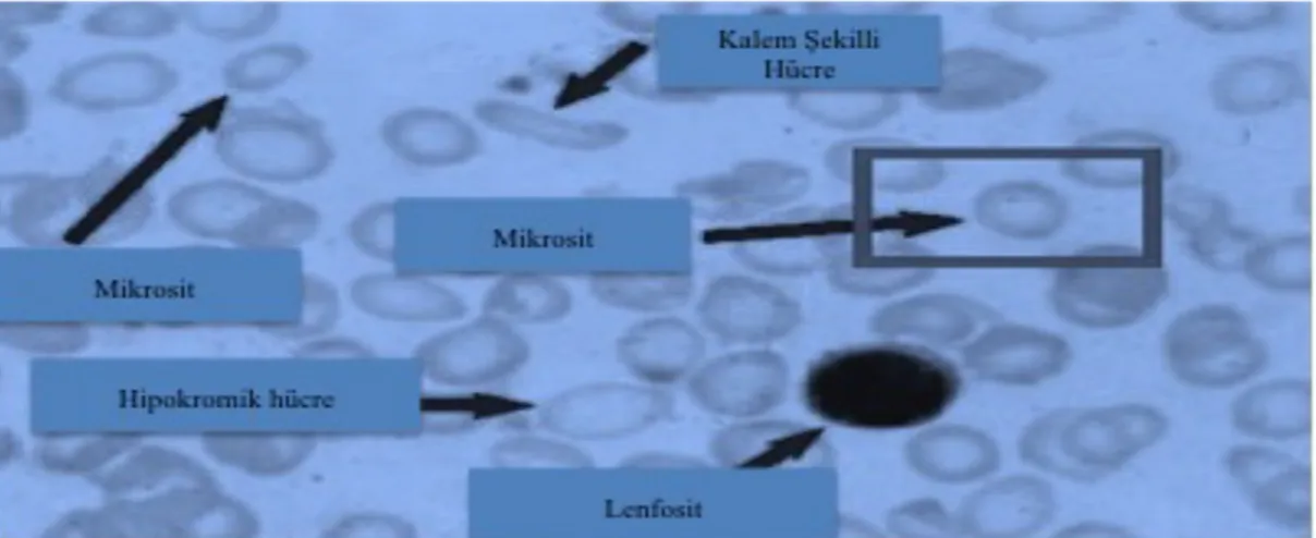 Şekil 2.6: Bir kan yaymasında, mikrositoz, anizositos ve hipokromi örneği.Orjinal şekilden modifiye  edilmiştir ( http://ehealthhall.com/microcytosis-symptoms-causes.html)