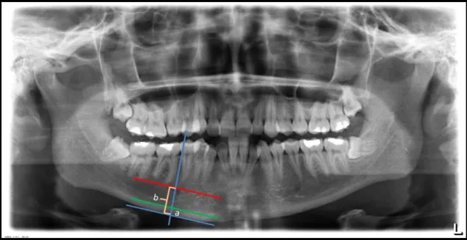 Şekil  3.3.  Panoramik  radyografi  kullanılarak  yapılan  PMI  ölçümü;  a:MKK,  b:  mental  foramenden  mandibulanıın alt sınırına olan uzaklık