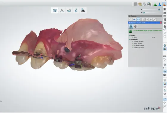 Şekil  3.16.  Kanin  distalizasyonu  tamamlandıktan  sonra  kanin  braketinin  mezyal  kenarı  ile  molar  bandının mezyal kenarı arasındaki mesafenin 3B olarak ölçülmesi
