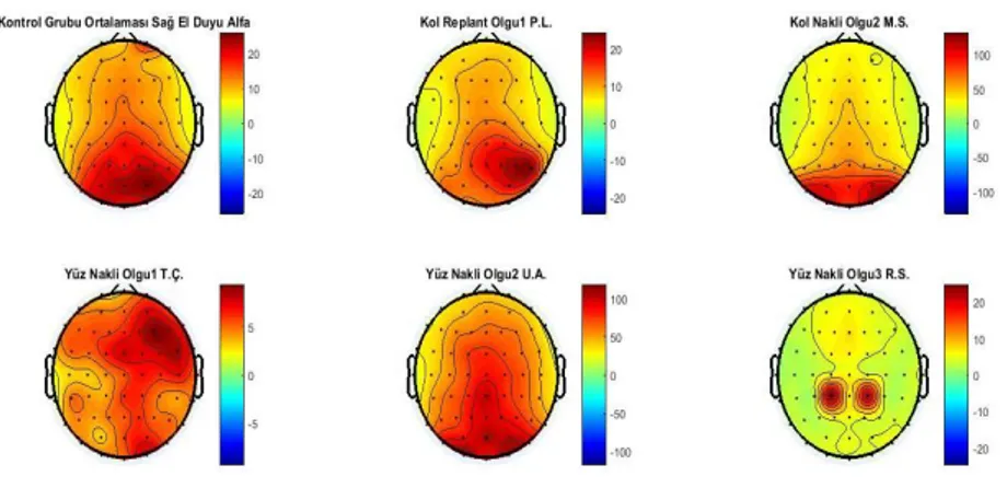 Şekil 4.1. Kontrol grubu ve nakil grubunun sağ el duyu uyarımı için alfa bandının  topografik haritalanması 