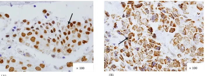 Figure 1. Positive p33(ING1b) immunohistochemical staining. (A) Invasive lobular breast carcinoma tissue strongly expressing  p33(ING1b) only in the nuclei of tumor cells