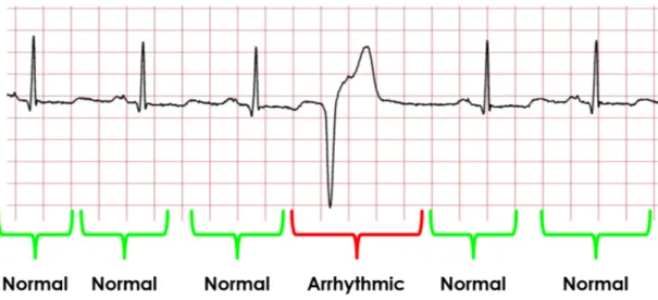 Figure 2.2 shows an example ECG with five normal and one arrhythmic heart beat. As can be seen from the figure, the arrhythmic activity can easily be distinguished from the other regular waveforms