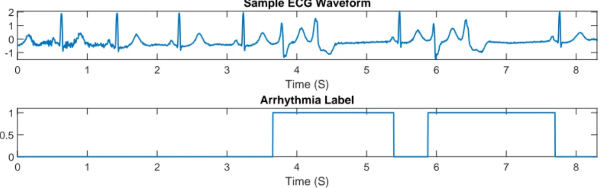 Figure 3.1: The sample ECG waveform alongside the labels highlighting the arrhythmic beats.