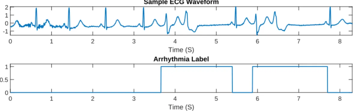 Figure 3.1: The sample ECG waveform alongside the labels highlighting the arrhythmic beats.