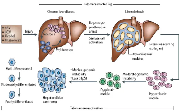 Figure 1.1: Histopathologic progression and molecular features of HCC. After hepatic injury incurred by  any one of several factors (HBV, HCV, alcohol and aflatoxin B1) there is necrosis followed by hepatocyte  proliferation