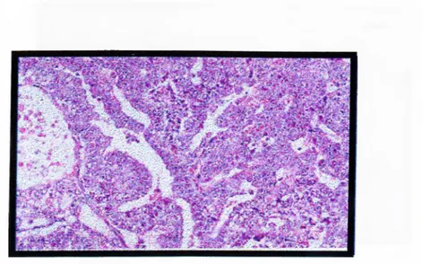 Figure  1.7.3.1:  The histological appearance of embryonal carcinoma