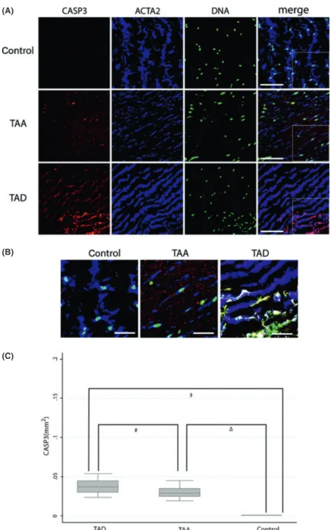 Figure 4 Caspase 3 (CASP3) activity in vascular smooth muscle cells (VSMCs). Confocal microscopic images of the aortas from control and patients with thoracic aortic aneurysm (TAA), type-A aortic dissections (TAD [CASP3, red signal; ACTA2, blue signal; nuc