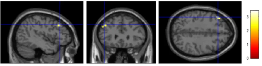 Figure 3.4: The increased activation due to proneness to psychosis for the com- com-putation in working memory contrast result (PP>NPP).