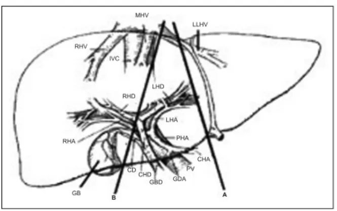 FIGURE 2: Complete recipients′ left lobe implantation. Interposition grafts are used for both hepatic artery and portal vein to assure adequate length.