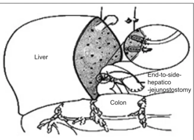 FIGURE 4: Right lobe transplantation: anastamoses in the recipient.