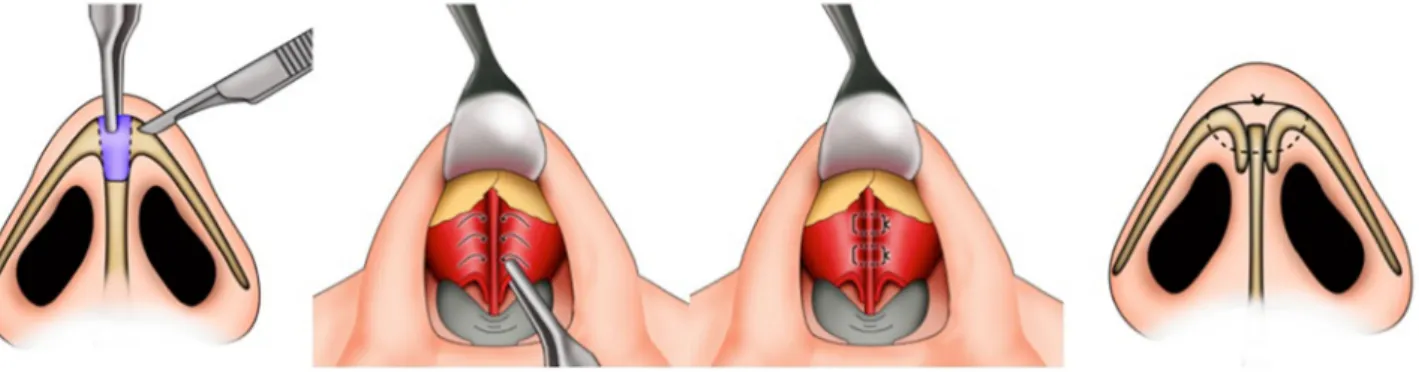 Fig. 1 Upper lateral cartilage fold-in flaps