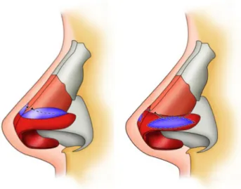 Fig. 3 Nasal tipoplasty with medially placed individual tip sutures
