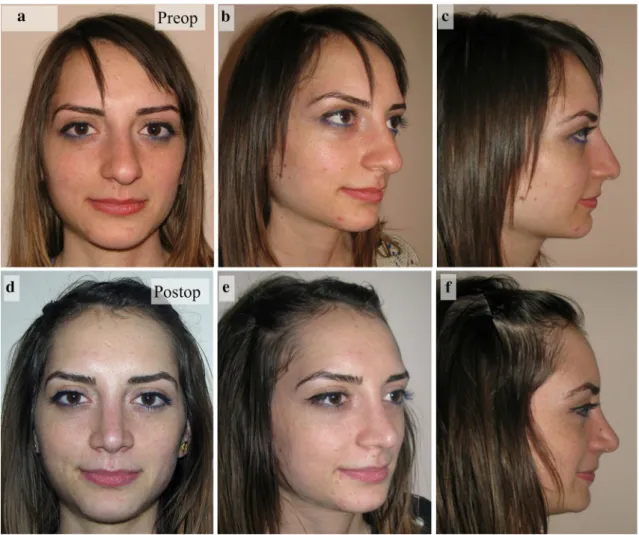 Fig. 5 22 years old female. (a–c) Preoperative and (d–f) Postoperative 8 months pictures