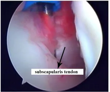 Fig. 1 Arthroscopic release of subscapularis tendon