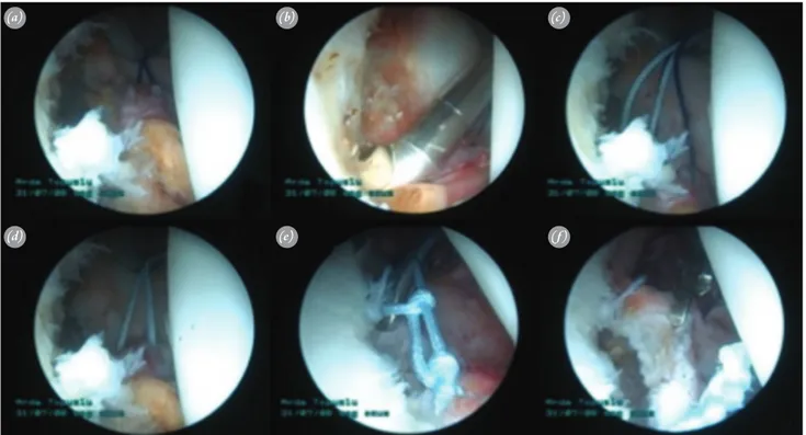 Figure 1 shows the images obtained during arthroscopy  and Figure 2 illustrates the schematic diagram of the  procedure