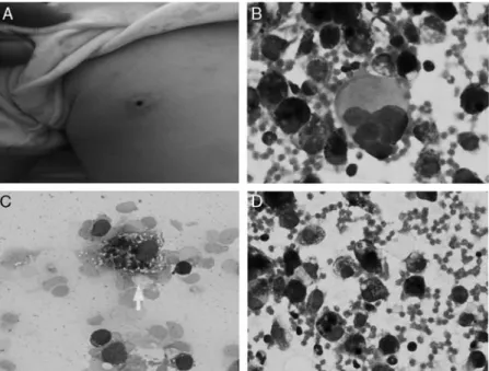 FIGURE 2. A, Unilateral bloody nipple discharge of the second case. B, Megakaryocytes in the smear prepared from the nipple discharge representing extramedullary hematopoiesis