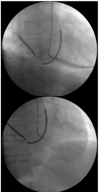 Figure 1. (A) Venography showing the course of the right superior vena cava (SVC) (B) Venography of the huge coronary sinus (CS) with pigtail catheter