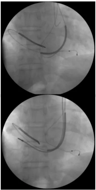 Figure 3. (A) LV lead was introduced succesfully into the posterolateral branch over the guide wire