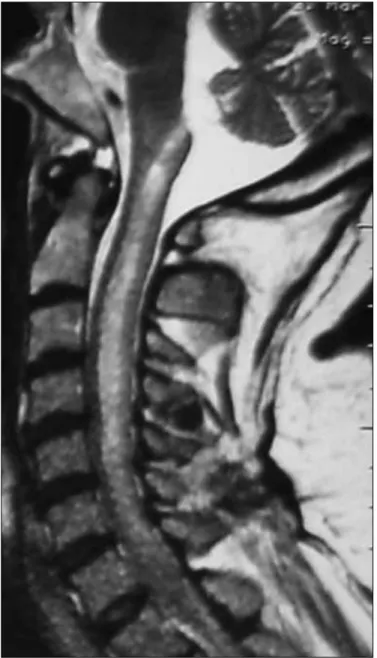 Figure  3.  T2  Sagital  Servical  MR  Image  Shows  Longitudi- Longitudi-nally Extensive Myelitis