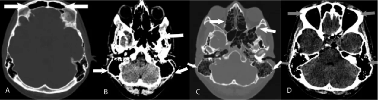 Figure 1.  A) Axial computed tomography in bone window. B) Axial computed tomography in parenchyma window