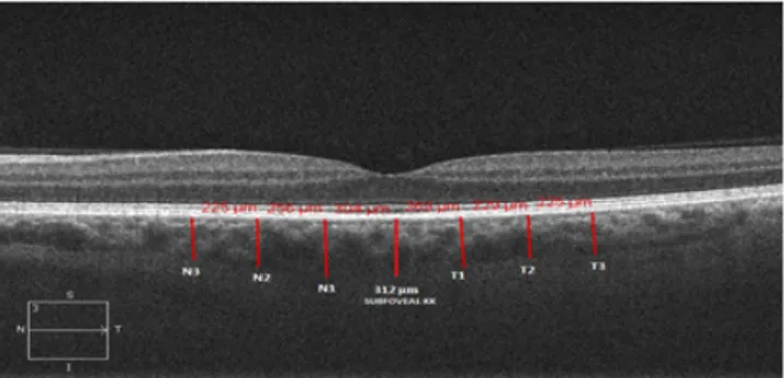 Figure 1.Choroidal thickness measurement in optical coherence tomography, cen- cen-tral measurement was considered as subfoveal, consecutive mesurements were  considered as N1, N2, N3, T1,T2,T3 at intervals of 500 µm.