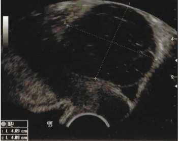 Fig. 3 Transvaginal ultrasound image of a heterogeneous right twisted paratubal cyst (calipers), misdiagnosed as ovarian torsion after Doppler ultrasound
