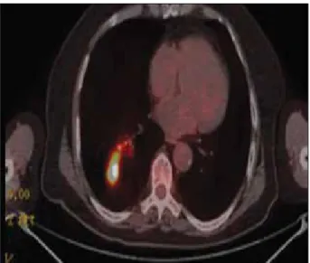 Fig. 3.  A 12-mm diameter pulmonary nodule with sub- sub-pleural placement in the anterior segment of the  right upper lobe.