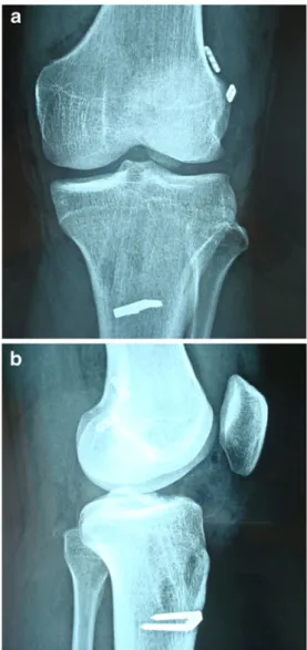 Fig. 2 a A 27-year-old male patient that underwent double-bundle ACL reconstruction. b Lateral view