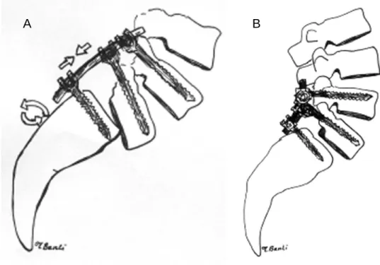 Figure -1. Sagittal plane correction technique with posterior instrumentation in the patient  with high dysplastic developmental spondylolisthesis