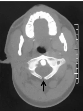 Figure 1: Lateral cervical spine radiograph shows two posterior  hemiarch of C1 (arrows)