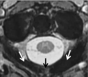 Figure 6: Sagittal T2-weighted MR image. There is no spinal cord  compression.