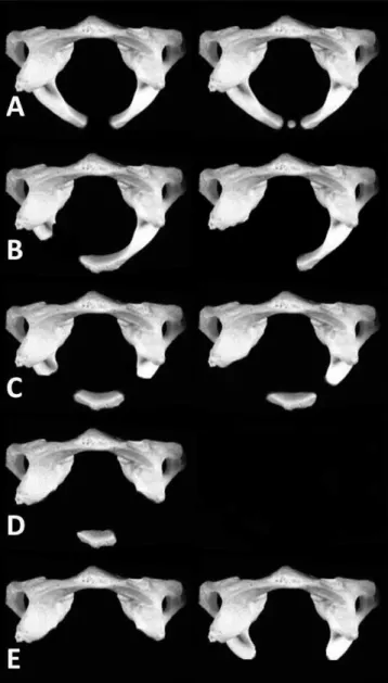 Figure 8: The figure shows the types of Curarino’s classification  in hypoplasia of C1.