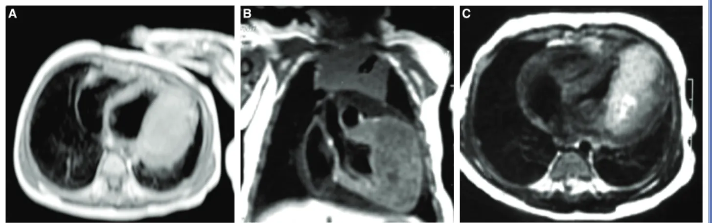 Figure 1. (A) Axial Computed Tomography showing the intraventricular mass. (B) Coronal T1 Weighted image of the intraven- intraven-tricular mass isointense to the myocardium