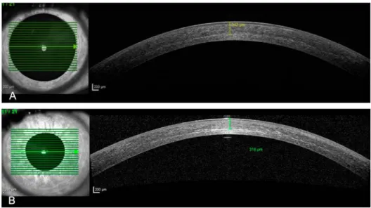 FIGURE 4. Demarcation line 1 month after (A) TE DAI-CXL and (B) C-CXL.