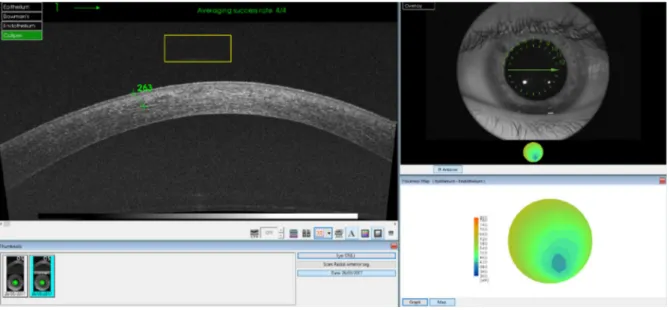 Fig. 2 Corneal stromal demarcation line image with anterior segment optical coherence tomography 1 month after accelerated corneal collagen cross-linking using hypotonic solution (10 min at 9 mW/cm 2 , total surface dose of 5.4 J/cm 2 )