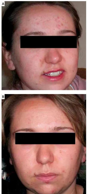 Fig. 1. A) A 17-year-old girl with facial acne vulgaris and acne grade   of 2. B) The same patient, one month after surgery with acne grade of 1