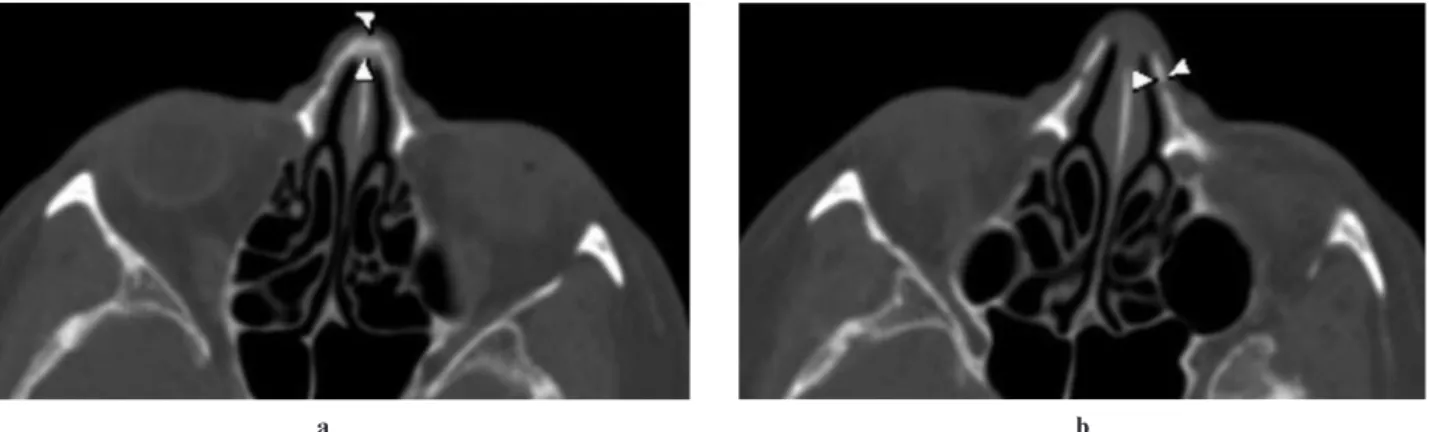 Figure 1 Axial CT image demonstrating the measurements of the nasal bone thickness. The arrowheads show the medial (a) and lateral (b) osteotomy points