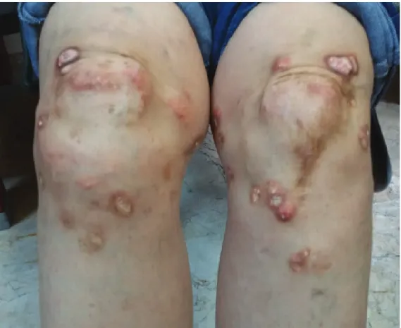 Figure 1. Multiple erythematous and whitish papules/nodules, some of which have a chalky white ma- ma-terial on the around knees