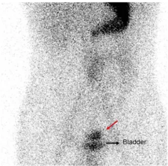 Figure 2. Tc-99 m pertechnetate Meckel scintigraphy. Postmic- Postmic-ture, posterior static images show posteriorly localized focal  in-creased activity, superior of the bladder (black arrow)