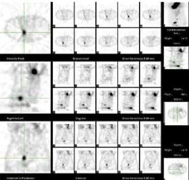 Figure 3. SPECT imaging demonstrated focal uptake in the right  lower quadrant, localized posterior and superior to the urinary  bladder.