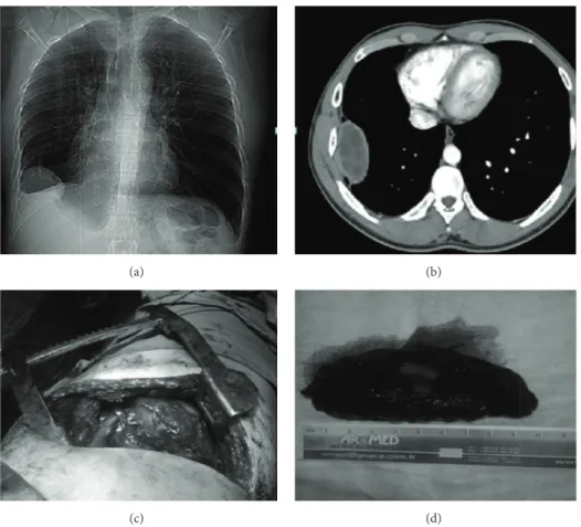 Figure 1: Chest X-ray image of the extrapulmonary intrathoracic hydatid cyst in the first case (a)