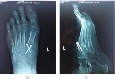 Figure 3: (a) Anteroposterior X-ray view 7 months after surgery. (b) Lateral X-ray view 7 months after surgery.