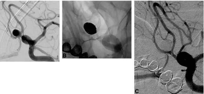 FIG 2. Procedural DSA images of patient 4. A, A 9-mm AcomA aneurysm with a wide neck extending to both A2 segments