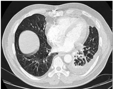 Figure 7. Pleural effusion 