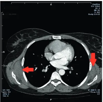 Figure 1: Thorax CT of a case with bilateral elastoﬁbroma dorsi. CT scan demonstrates an 8 × 8 cm on the left and 9.5 × 7 cm on the right side regular soft-tissue masses (arrowheads) posterior to both scapulas