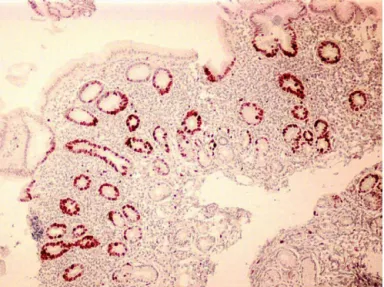 Fig. 1. Detection of apoptosis by TUNEL assay in a patient with H. pylori infection.