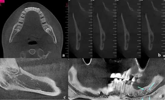 Fig. 1 Reconstructed a axial, b cross-sectional, c sagittal, d panoramic CBCT images used for detection and measurement of the bifid mandibular canals (arrows)