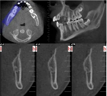 FIGURE 1. Reconstructed axial, cross-sectional, sagittal CBCT images used for detection and measurement of the bifid mandibular canals.