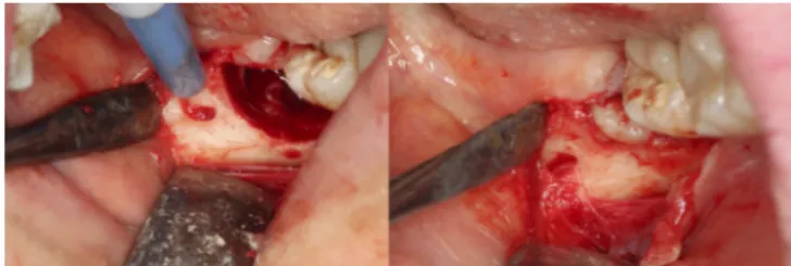 FIGURE 6. Photos showing third-molar extraction of 16 year old female with bifid mandibular canal